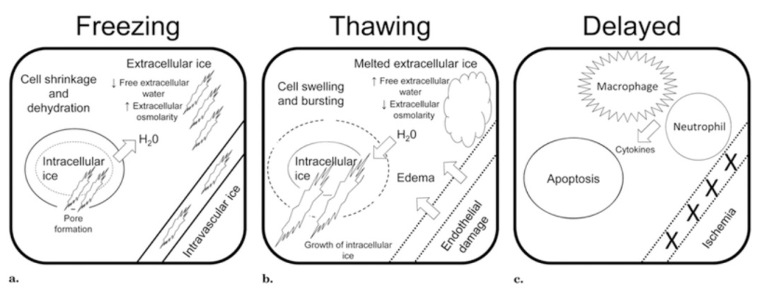 腫瘤治療界的「高冷之花」——腫瘤微創(chuàng)冷凍消融，國產(chǎn)替代設(shè)備空間巨大